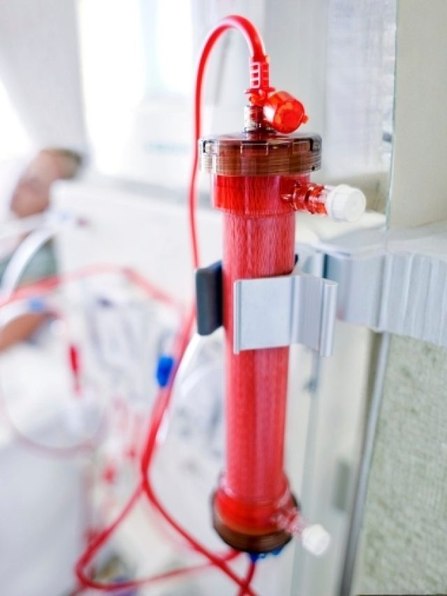 5  Key Performance Advantages of Nephroxa Dialyzers in Hemodialysis