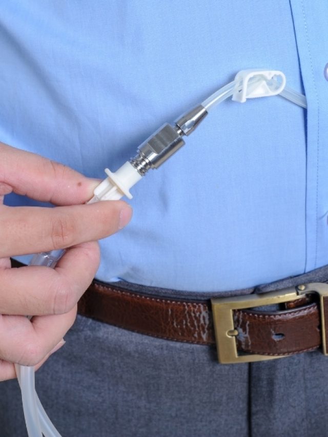 How Does Catheter Prevent Blood Recirculation During Dialysis